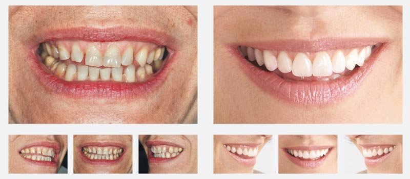 Veneers Lumineers Kosten Vorher Nachher Bilder Info Medizin