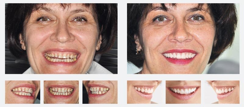 Veneers Lumineers Kosten Vorher Nachher Bilder Info Medizin