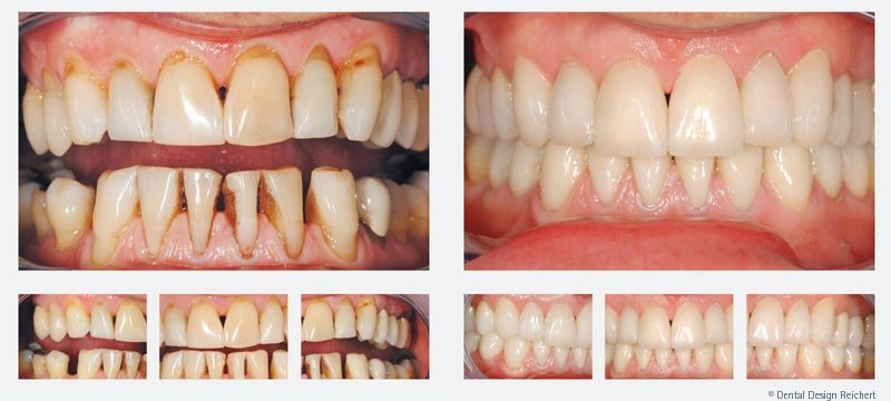 Veneers Lumineers Kosten Vorher Nachher Bilder Info Medizin