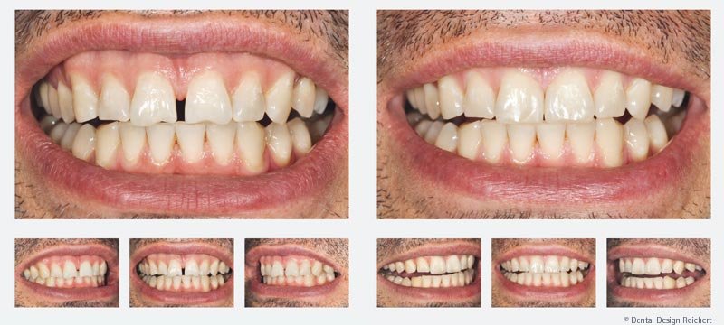 Veneers Lumineers Kosten Vorher Nachher Bilder Info Medizin